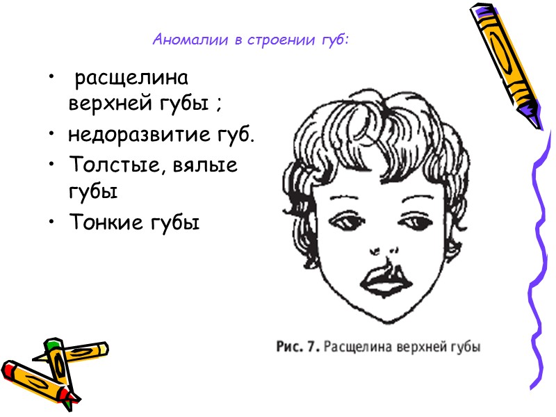 Аномалии в строении губ:  расщелина верхней губы ;  недоразвитие губ. Толстые, вялые